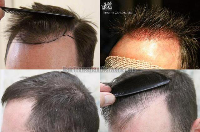 Hair transplantation surgery before and after photos