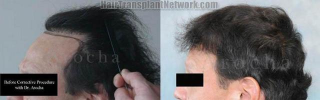 Left View hair transplant correction procedure