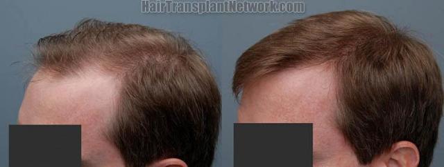 Hair restoration procedure results