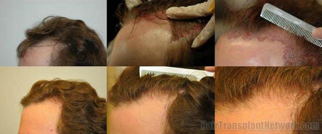 Left view - Hair replacement surgery pictures