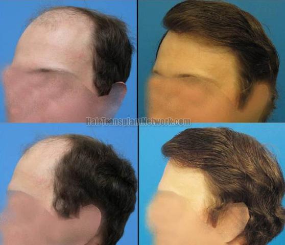 Hair transplantation surgery before and after images