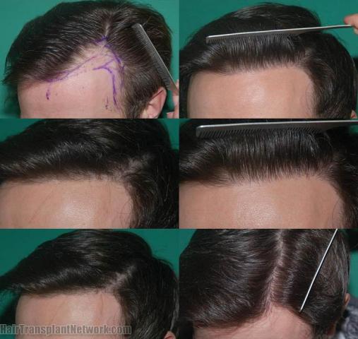 Hair restoration procedure before and after pictures