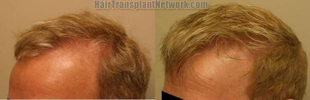 Hair transplantation surgery before and after images