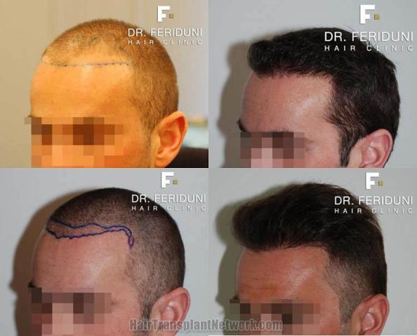 Hair transplantation surgery before and after images