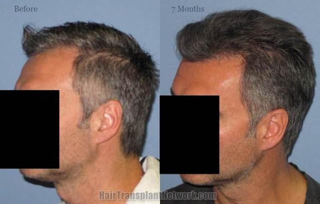 Hair transplantation surgery before and after pictures