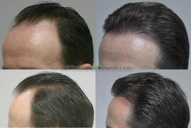 Hair transplantation surgery before and after pictures