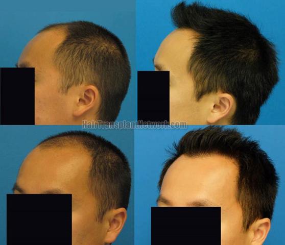 Hair transplantation surgery before and after pictures