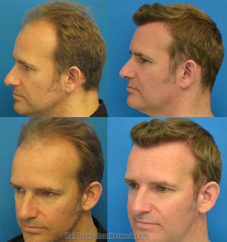 Hair transplantation surgery before and after pictures