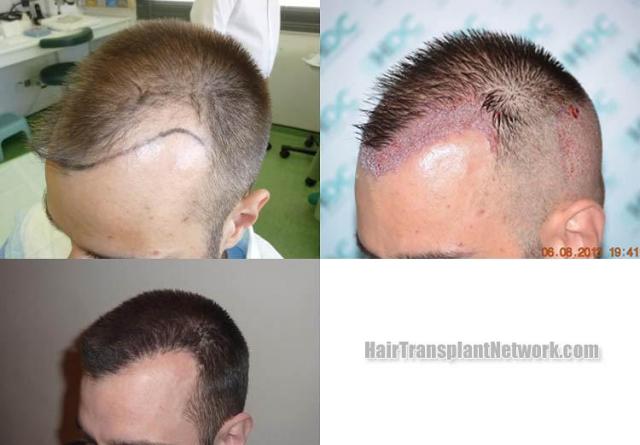 Hair transplantation surgery before and after pictures