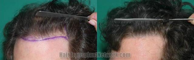 Hair transplantation surgery before and after pictures