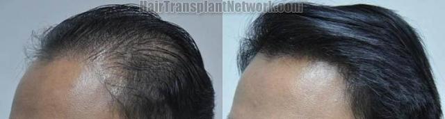 Hair transplantation surgery before and after pictures