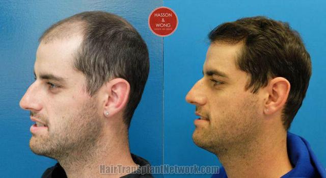 Hair transplantation surgery before and after photos