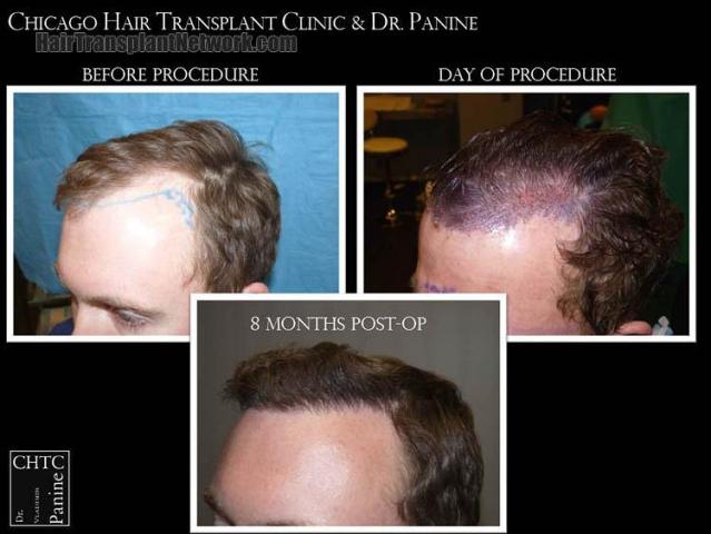 Hair transplantation surgery before and after pictures