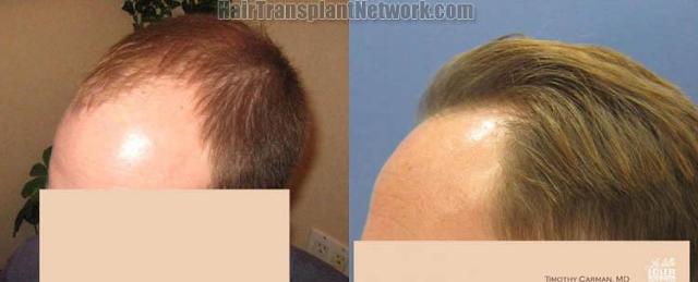 Hair transplantation surgery before and after images