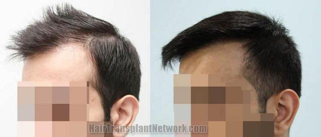 Hair transplantation surgery before and after pictures