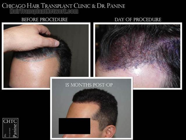 Hair transplantation surgery before and after images