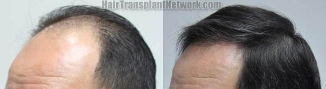 Hair restoration procedure before and after pictures