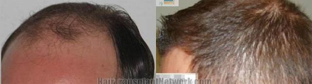 Hair transplantation surgery before and after pictures