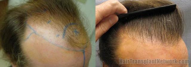 Hair restoration procedure results