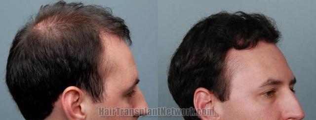 Right view before and after hair transplantation