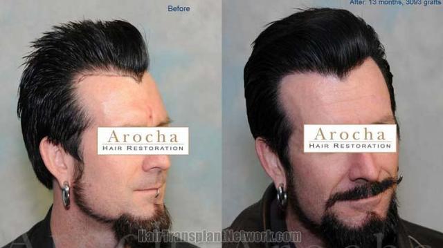 Before and after surgical hair restoration images