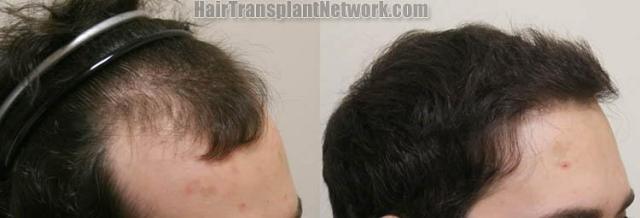 Before and after hair transplant procedure images