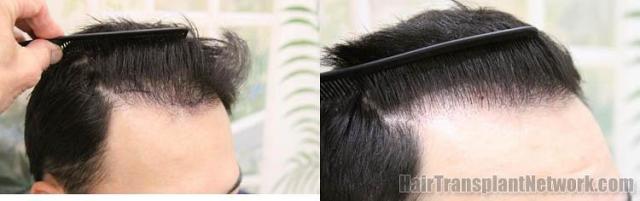 Hair transplantation surgery before and after photos