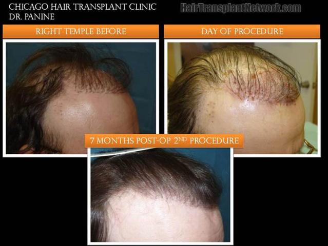 Hair restoration procedure before and after results