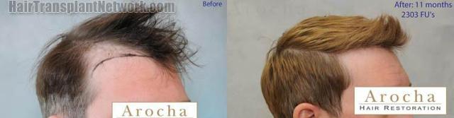 Hair restoration procedure before and after pictures