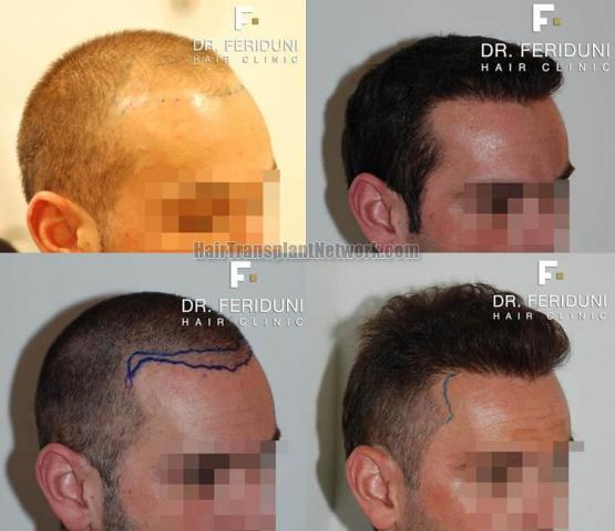 Hair transplantation surgery before and after images