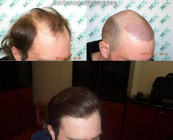 Hair restoration procedure before and after results