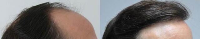 Hair restoration procedure before and after results