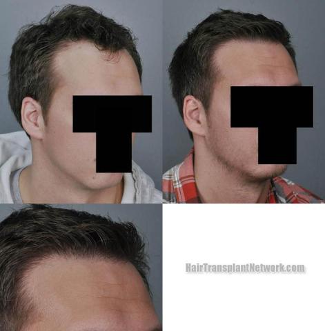 Hair transplantation surgery before and after images