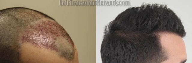 Hair transplantation surgery before and after photos