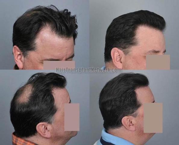 Hair transplantation surgery before and after images