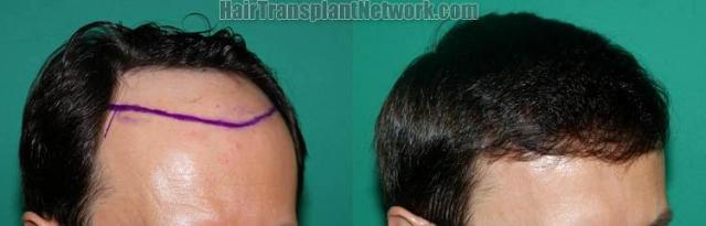 Hair transplantation surgery before and after photos