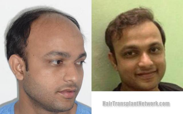 Hair transplantation surgery before and after photos