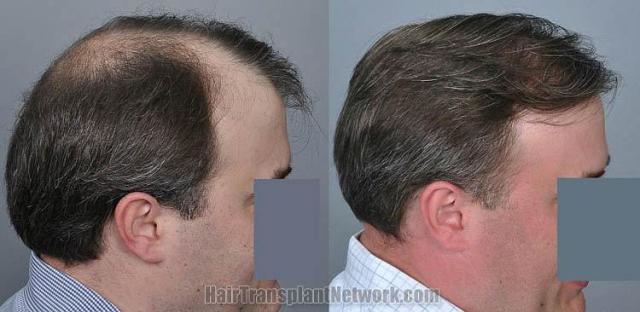 Hair transplantation surgery before and after images