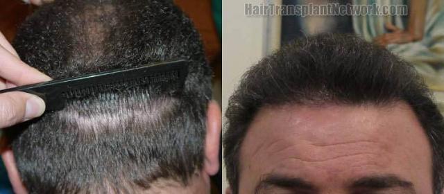 Hair transplantation surgery before and after images