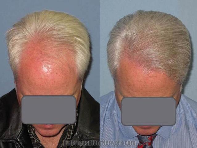 Hair restoration procedure before and after pictures