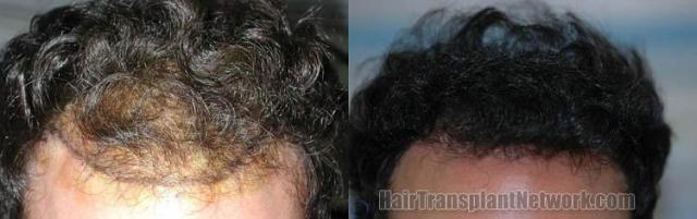 Hair transplantation surgery before and after images