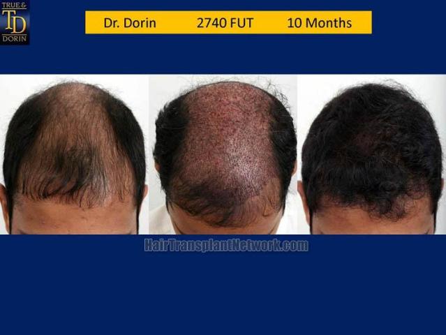 Hair transplantation surgery before and after pictures