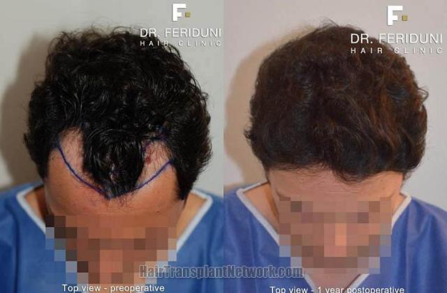 Top view - Before and after surgical hair replacement