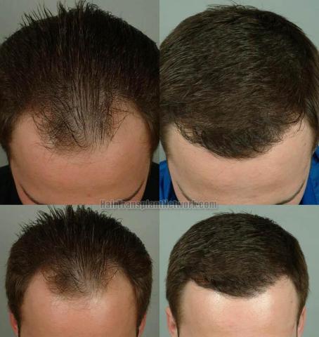 Hair restoration procedure before and after results