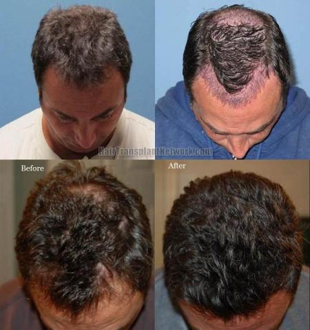 Hair transplantation surgery before and after photos