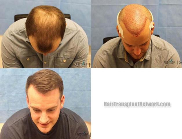 Hair transplantation surgery before and after images