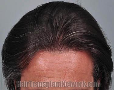 Top view before and after hair restoration results