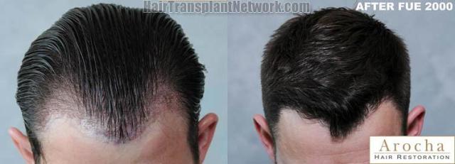 Hair transplantation surgery before and after photos