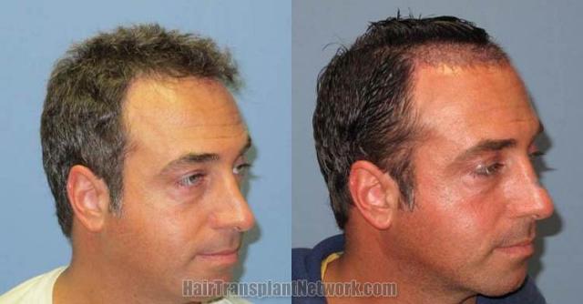 Hair transplantation surgery before and after pictures