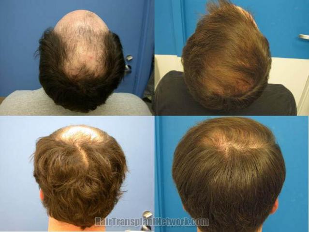 Hair transplantation procedure photo results